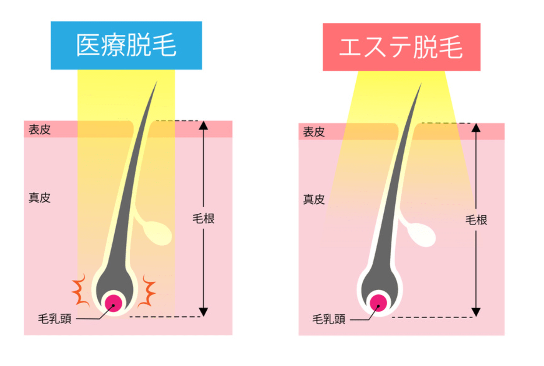 医療脱毛とエステ脱毛の違い